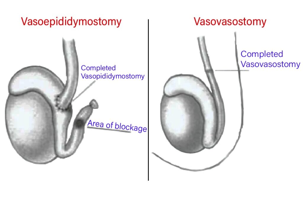 Diagram comparing vasovasostomy and vasoepididymostomy techniques used in vasectomy reversal in Colombia to bypass or reconnect blocked sperm pathways